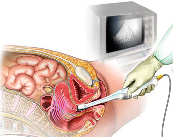 سونوگرافی واژینال- سونوگرافی واژینال در بارداری